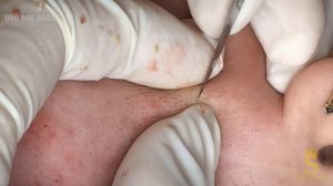 Воспаленные угри с кровоподтеками: черные точки, скрытые прыщи и гематомы. Часть 2