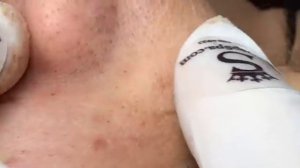 Как легко удалить прыщи на лице. #удалениепрыщей #уходзалицом