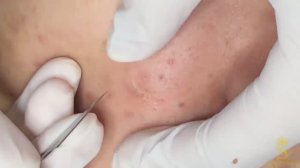 Эффективные способы лечения прыщей #лечениеакне #черныеточки #белыеугри #скрытоеакне