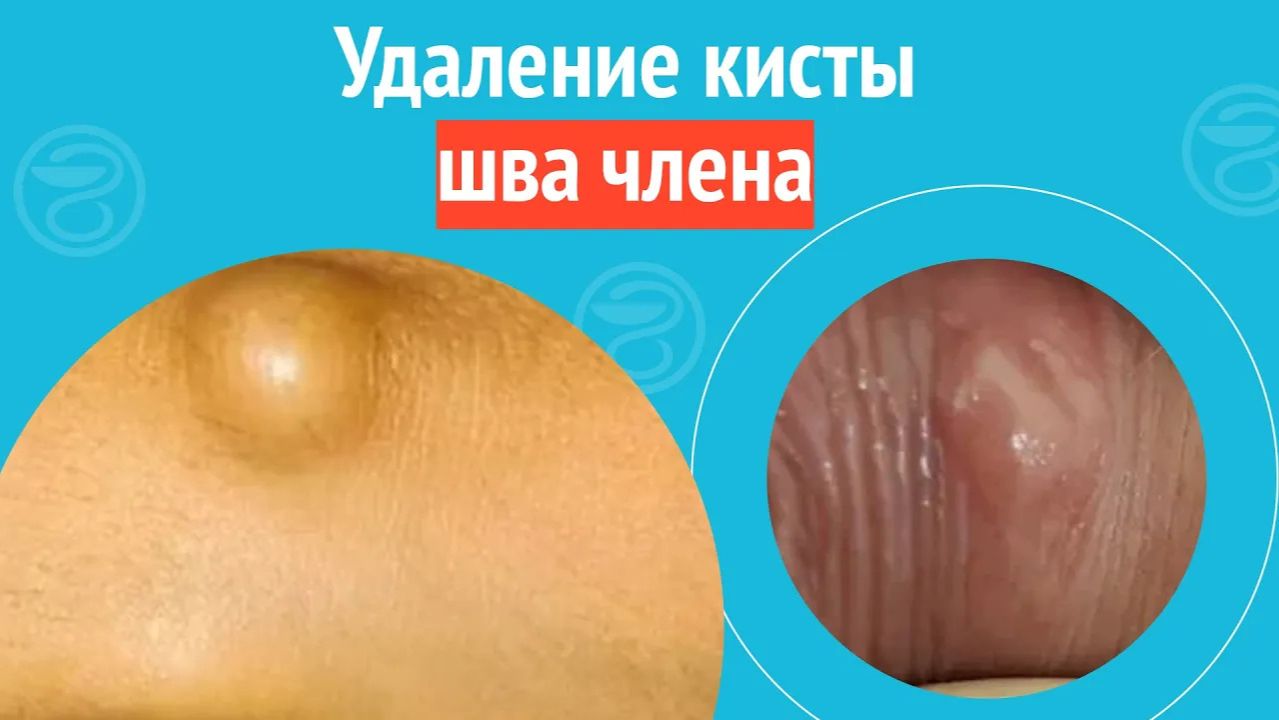 ▶️ Удаление кисты шва члена. Клинический случай №1467 смотреть онлайн