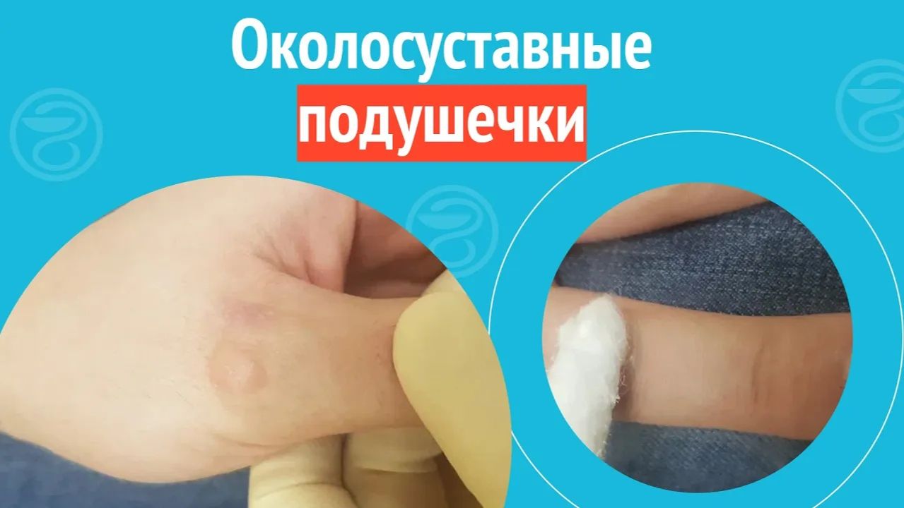 ✋ Околосуставные подушечки. Клинический случай №1459 смотреть онлайн