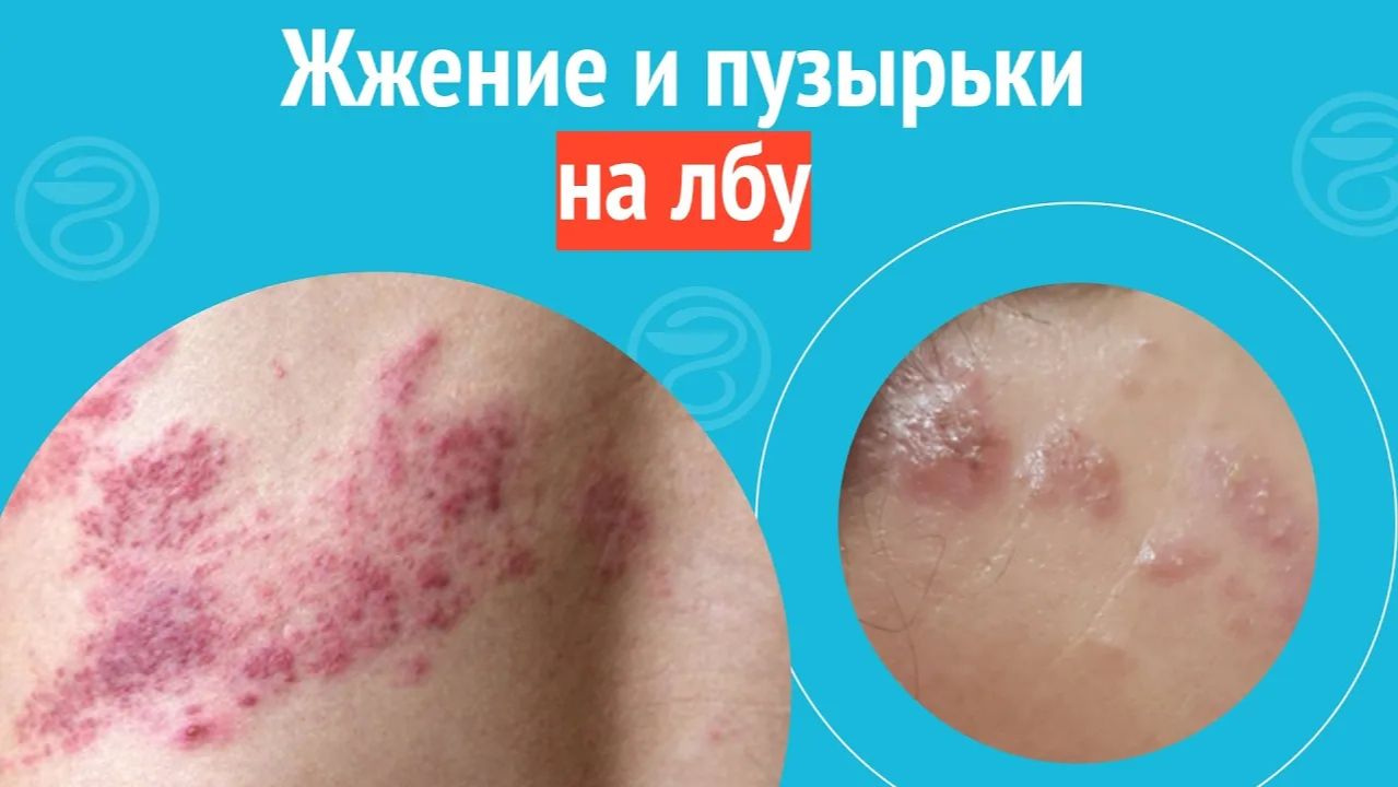 🫧 Жжение и пузырьки на лбу. Клинический случай №1465 смотреть онлайн