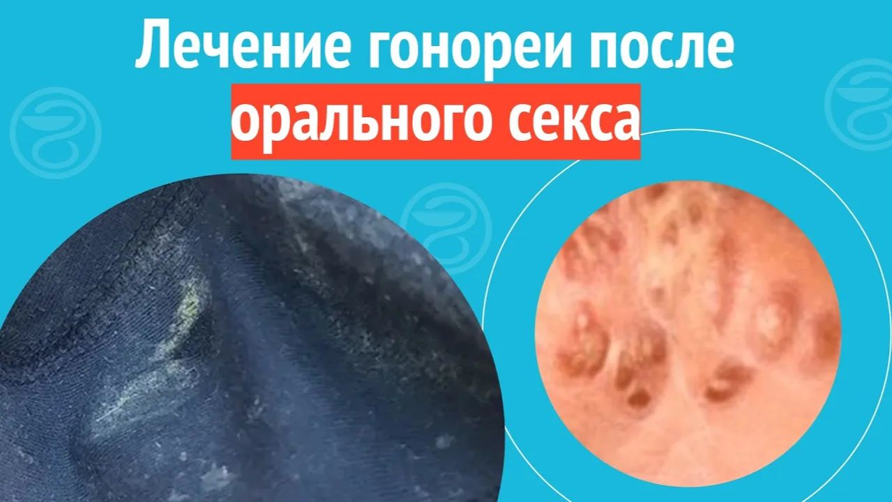 🩺 Лечение гонореи после орального секса. Клинический случай №1448 смотреть онлайн