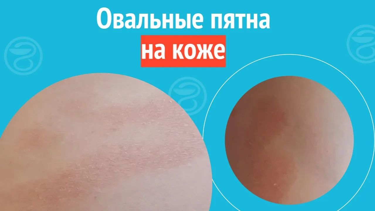 ⏺️ Овальные пятна на коже. Клинический случай №1446 смотреть онлайн