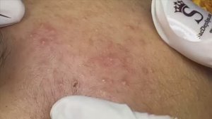 Белые угри на чувствительной коже. #белыеугри #чувствительнаякожа #комедоны