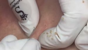 Удаление прыщей на груди у мужчины. #прыщинагруди #мужскойуход #чисткатела #уходзателом