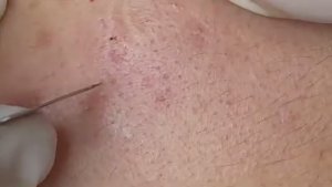 Подкожный гематомный прыщ. #гематомныйпрыщ #подкожноевоспаление #лечениепрыщей