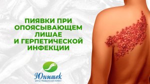 Пиявки при опоясывающем лишае и герпетической инфекции