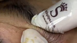 Полное извлечение скрытых прыщей и черных точек. #белыеугри #черныеточки #экстракция #чисткалица