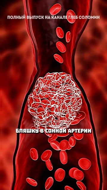 Мощнейшие факторы развития атеросклероза смотреть онлайн