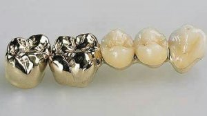 1) .5часов спустя после установки зубов! Новый Сериал. 1 серия. плей лист. После установки!