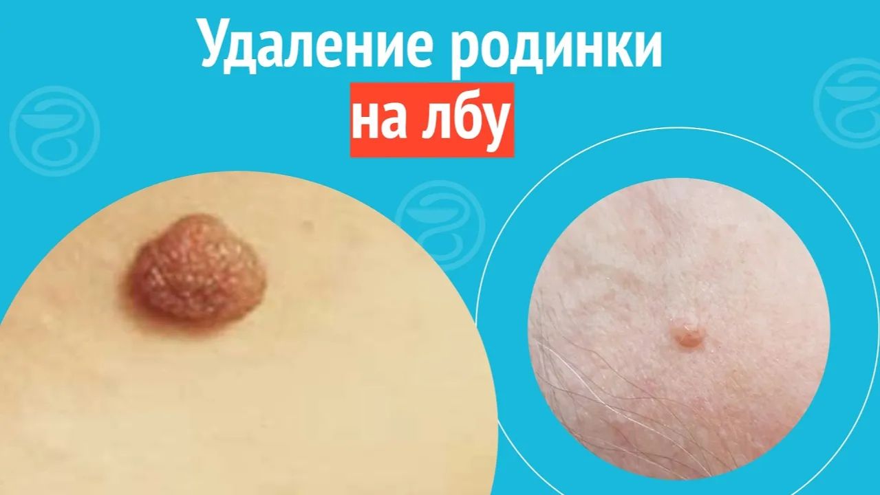 👉 Удаление родинки на лбу. Клинический случай №1454 смотреть онлайн