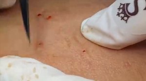 Белые угри и сальные нити на коже. #сальныенити #черныеточки #белыеугри