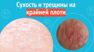 😧 Сухость и трещины на крайней плоти. Клинический случай №1453