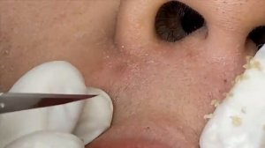 Лечение прыщей, скрытых под кожей. #лечениеподкожныхпрыщей #скрытоеакне