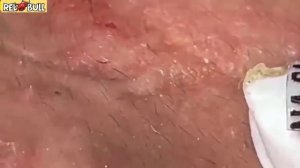 Глубокое очищение от прыщей. Антистресс-процедура для мгновенного облегчения кожи 𝟗𝟎𝟎𝟑𝟓𝟐