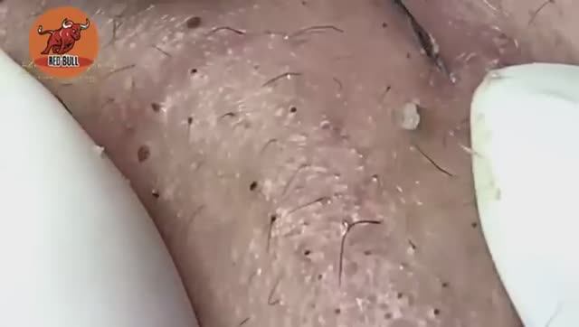 Глубокое очищение от прыщей. Антистресс-процедура для мгновенного облегчения кожи 𝟗𝟎𝟎𝟑𝟒𝟗 смотреть онлайн