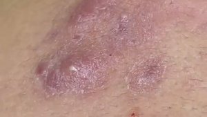 Воспалённые прыщи с гематомами на скулах и в зоне подбородка. #гематомныйпрыщ #воспаленныепрыщи