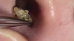 Прыщи. Огромные прыщи.  Выдавливание прыщей. Черная точка #Прыщи