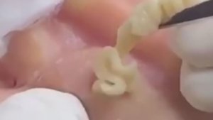 Прыщи _ Огромные прыщи _ Релакс с акне _ Выдавливание прыщей Черная точка #Прыщи