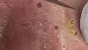 Прыщи _ Огромные прыщи _ Релакс с акне _ Выдавливание прыщей _ Черная точка #Прыщи