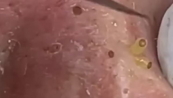 Прыщи _ Огромные прыщи _ Релакс с акне _ Выдавливание прыщей _ Черная точка #Прыщи