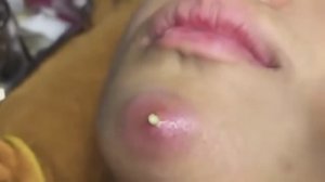 🌶️ШОК!!!🍓 ОГРОМНЫЙ ПРЫЩ НА БОРОДЕ  #комедоны #проблемнаякожа #уходзалицом