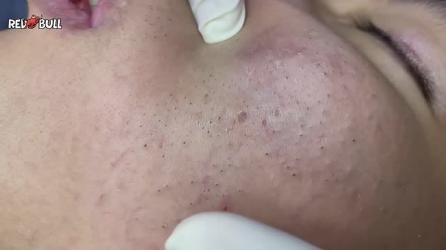 Удаление «спящих» подкожных прыщей. #𝟗𝟎𝟎𝟑𝟔𝟎 #прыщи #угри #угреваясыпь #удалениепрыщей смотреть онлайн