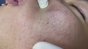 Удаление «спящих» подкожных прыщей. #𝟗𝟎𝟎𝟑𝟔𝟎  #прыщи #угри #угреваясыпь #удалениепрыщей