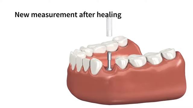 Penguin RFA - аппарат для измерения стабильности дентальных имплантатов.