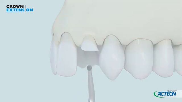 Piezotome Solo LED  Crown Extension 2