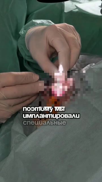 Сложный случай катаракты