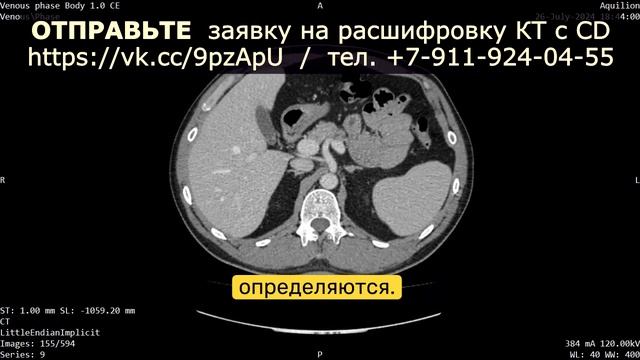 ПЕРЕГИБ желчного пузыря, УВЕЛИЧЕНА ПЕЧЕНЬ, АТЕРОСКЛЕР смотреть онлайн