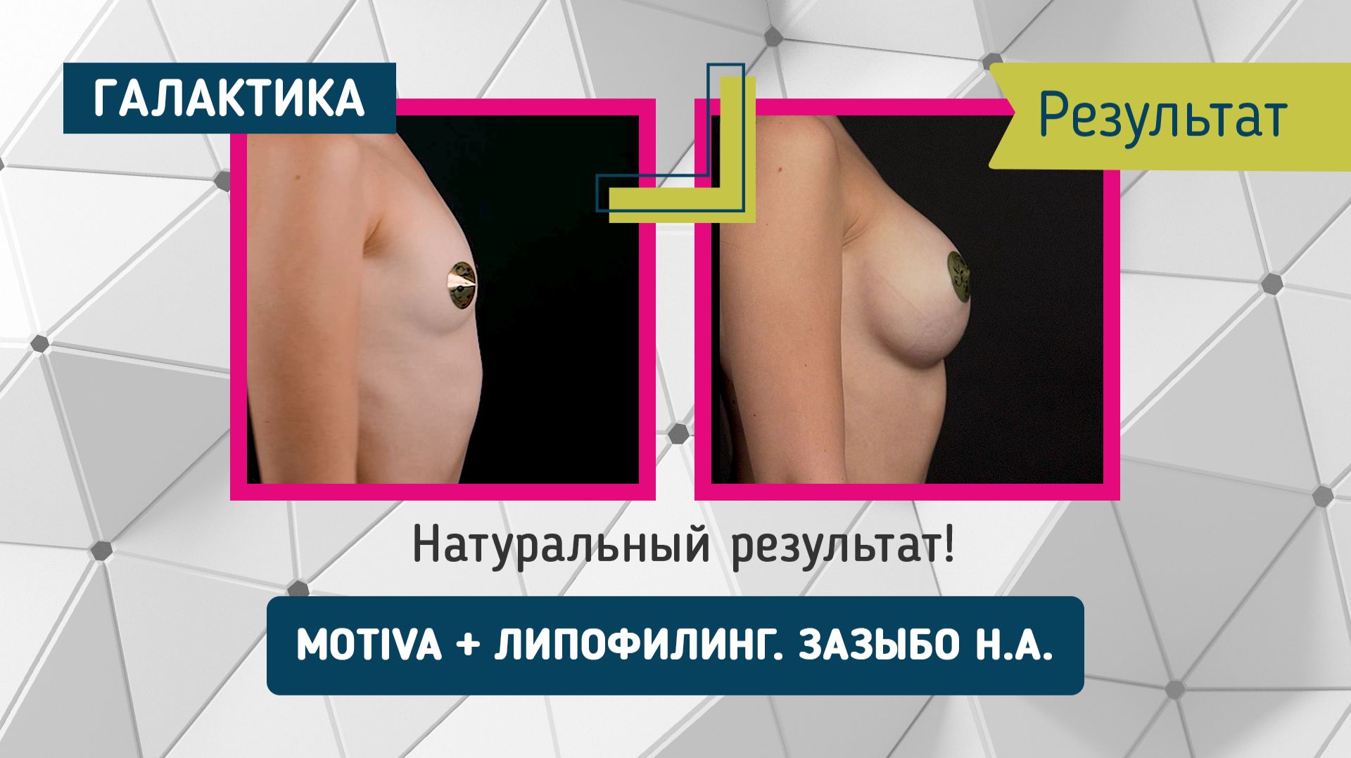 Motiva + липофилинг = натуральный результат маммопластики у Зазыбо Николая через год смотреть онлайн