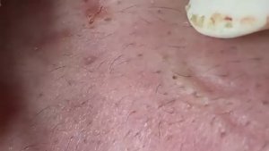 Удаление акне. асмр прыщи. Для расслабления #113. #акне #постакне #механическаячистка