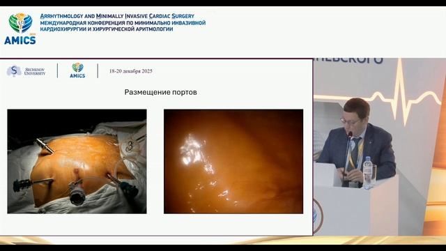 AMICS: робот-ассистированное АКШ — опыт УКБ1 им. Сеченова