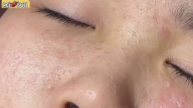 Выдавливание угрей, от которого мурашки по коже. Только для крепких нервов. #𝟗𝟎𝟎𝟑𝟗𝟒 смотреть онлайн