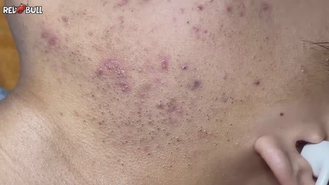 Прыщ-хамелеон. Казался простым, но оказался... #𝟗𝟎𝟎𝟑𝟕𝟑 смотреть онлайн