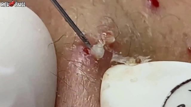 Вы не поверите, что было внутри. Вскрытие подкожного узла. #𝟗𝟎𝟎𝟑𝟗𝟐 смотреть онлайн