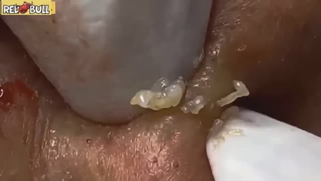 Мы достали ВСЕ прыщи. Чистка лица, после которой кожа стала новой. 𝟗𝟎𝟎𝟑𝟗𝟖 смотреть онлайн