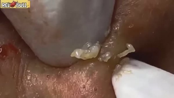 Мы достали ВСЕ прыщи. Чистка лица, после которой кожа стала новой. 𝟗𝟎𝟎𝟑𝟗𝟖