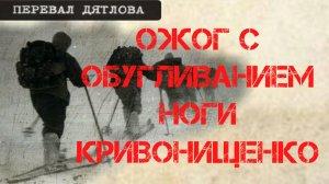 Перевал Дятлова. Ожог с обугливанием ноги Кривонищенко