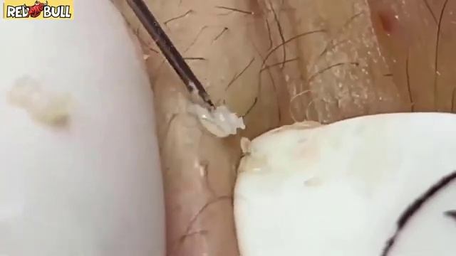 Секретное оружие против черных точек, которое скрывают косметологи. 𝟗𝟎𝟎𝟑𝟖𝟒 смотреть онлайн