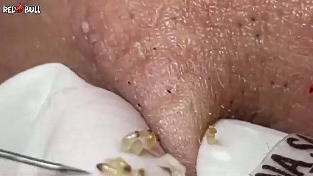 Выдавливание чёрных точек без кровотечения. Расслабление 𝟗𝟎𝟎𝟑𝟖𝟎. #черныеточки #чисткалица смотреть онлайн