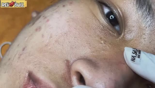 Белые угри и сальные нити на коже. 𝟗𝟎𝟎𝟑𝟗𝟑 #прыщи #угри #угреваясыпь #удалениепрыщей смотреть онлайн