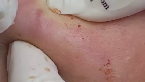 Лечение акне для чувствительной кожи. #чувствительнаякожа #лечениеакне