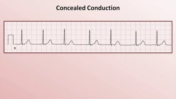 29 Advanced EKGs - Miscellaneous EP Topics
