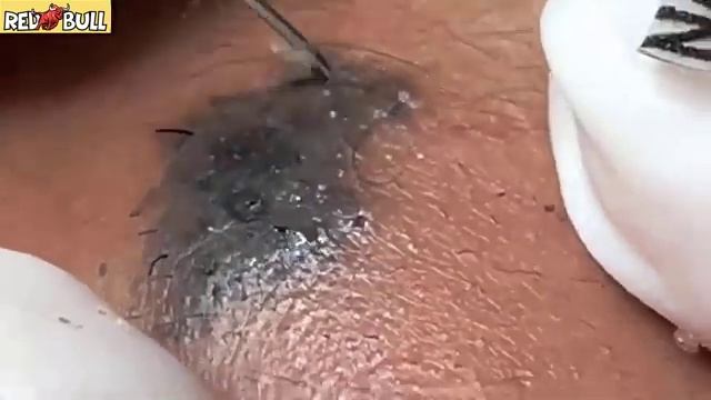 Чёрные и белые точки. Удаление. 𝟗𝟎𝟎𝟑𝟖𝟑 #черныеточки #чисткалица #проблемнаякожа смотреть онлайн