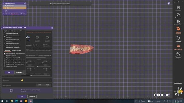 ExoCad гипсовка в виртуальный артикулятор смотреть онлайн