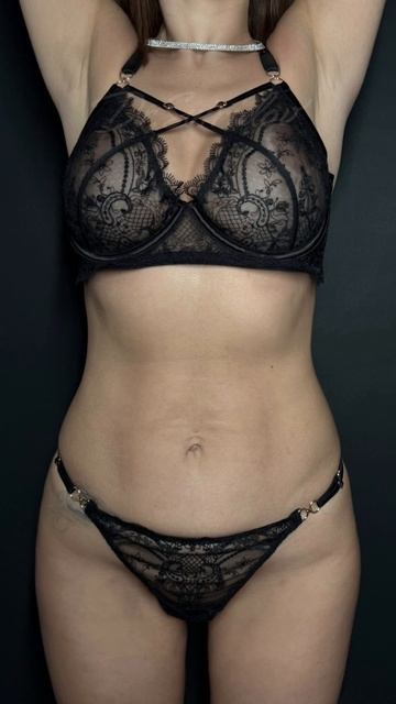 Липопластика тела! #сергейсвиридов смотреть онлайн